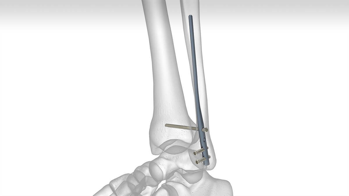 Acumed Fibula Rod System fibula-murtuma levytykseen. Nilkkamurtuma, proksimaalinen fibulan murtuma, nilkkaleikkaus ja hoito.