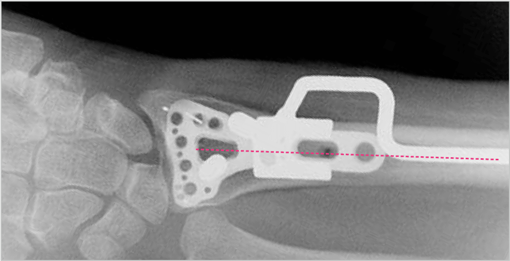 Distaalinen radiusmurtuma - Acu-Loc 2 järjestelmään kuuluva asemointikahva auttaa leikkaavaa ortopedia levyn sijoittamisessa.
