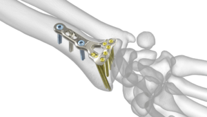 Acu Loc Wrist Plating System Summed Finland Oy