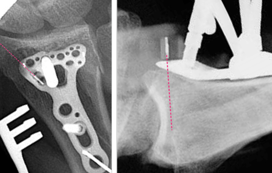 Hoidettaessa värttinäluun alaosan murtuma operatiivisesti, leikkaavalla ortopedilla on monia instrumentteja apuna. Poranohjaimen röntgenpositiiviset suuntamerkit auttavat levyn asemoinnissa.
